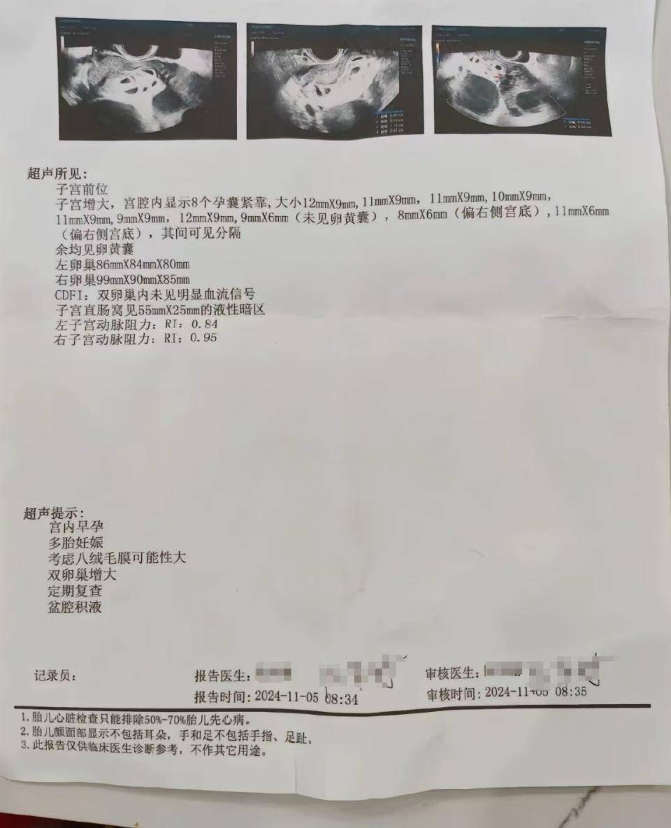 怀上9胞胎女子今日进行减胎手术：分两次进行，第一次减去四个胚胎，第二次减去三个