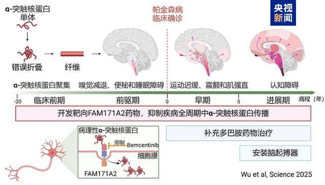 全球首次！复旦大学科研团队发现帕金森病全新治疗靶点